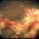 CMV Retinitis in a Patient with the Diagnosis of  AIDS
